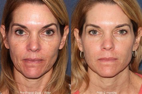 Questions About The Fraxel Laser Cosmetic Laser Dermatology Skin