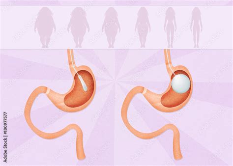 Intragastric Balloon Stock Illustration Adobe Stock