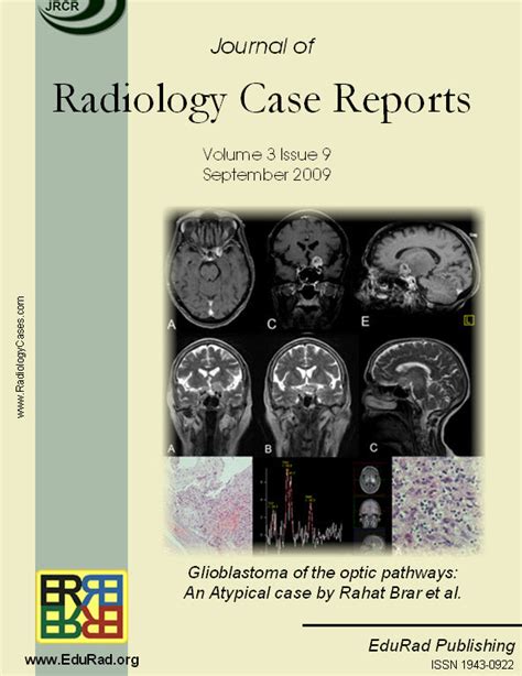 The Coumadin Ridge An Important Example Of A Left Atrial Pseudotumour