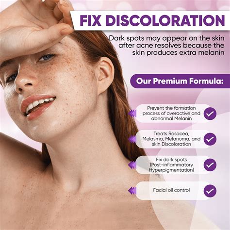 Snapklik.com : AOBBIY 10% Azelaic Acid Cream: Acne Treatment - Acne