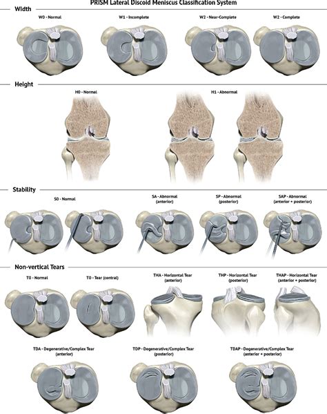 Table From Reliability Of A New Arthroscopic Discoid Lateral Meniscus