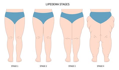 Una guía completa sobre las etapas y tipos de lipedema