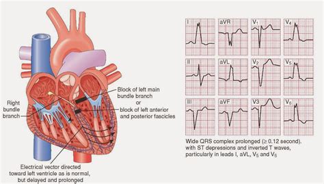 Left Bundle Branch Block Ina Ecg