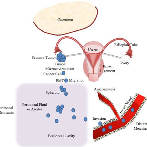 Model Of Ovarian Cancer Progression Including Cancer Cell Download Scientific Diagram