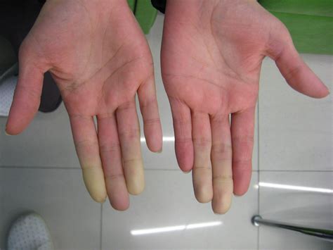 File:Secondary Raynaud's in Sjögren's syndrome 1.JPG - Wikimedia Commons