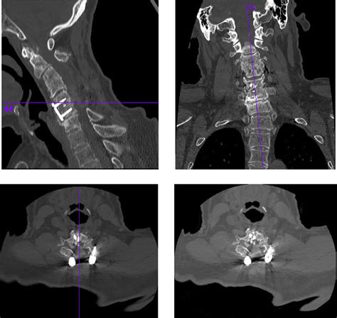 Case 3 Preoperative Cervical Spine Computed Tomography Images The Download Scientific Diagram