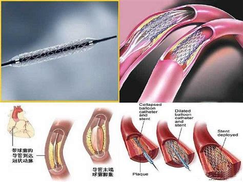 心血管医生告诉您：裸支架、药物支架、可降解支架的区别 知乎