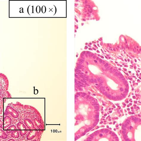 Histopathological Findings Of The Duodenal Biopsies H E Staining The