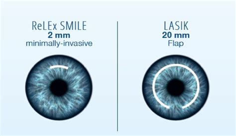 ReLEx SMILE Lasik Sight Center