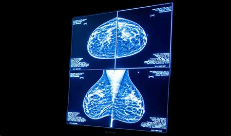 3d Mammography Cooley Dickinson Hospital