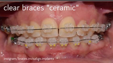 Clear braces vs Metal Braces. - Tabib Asnan