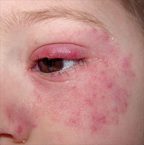 Periocular Rash Dermatology Jama Jama Network