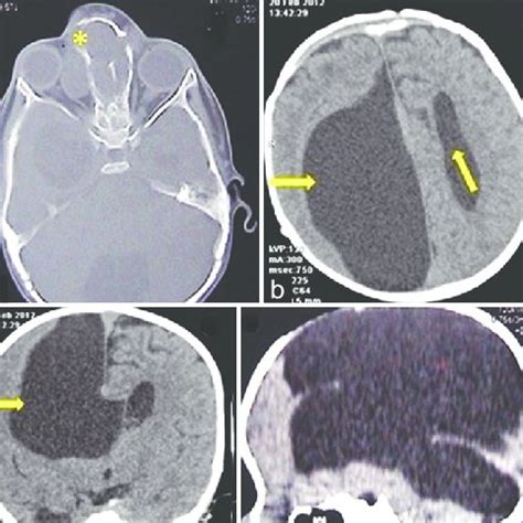 2-year-old female child with swelling at nasal bridge, (a) sagittal... | Download Scientific Diagram