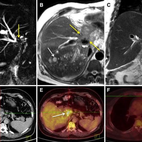 Cholangiocarcinoma: classification, diagnosis, staging, imaging ...