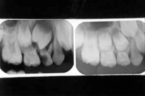 b: IOPA of Case 1, taurodontism of upper right and left first permanent ...