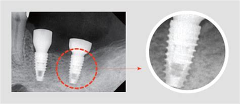 X ray sensors - Digital Dental