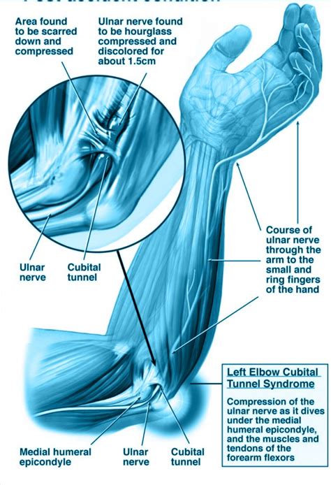 Dr Carlos Godoy Lesi N Por Compresi N Del Nervio Cubital