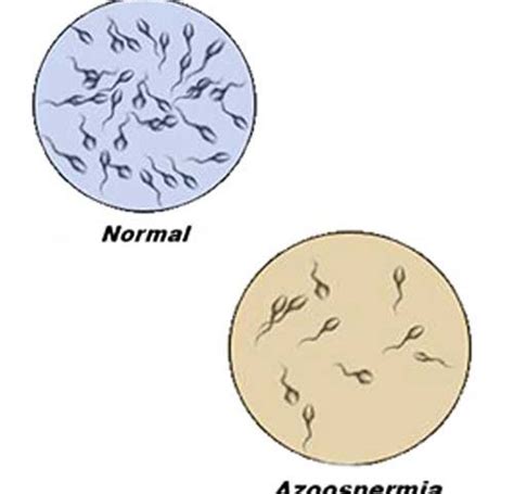 Azoospermia Male Infertility Causes Kjk Hospital And Fertility