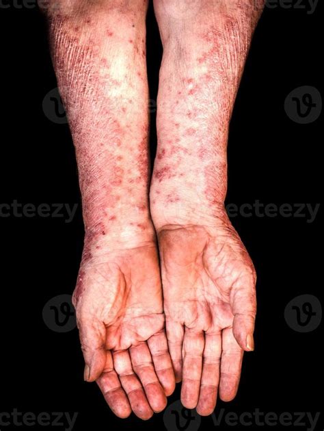 Hands with psoriasis 23030112 Stock Photo at Vecteezy