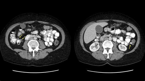 06 COMPLEMENTO Diverticulosis Y Enfermedad Diverticular Del Colon Pdf