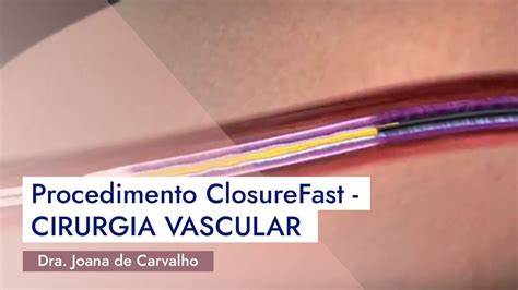 Procedimento Closurefast Cirurgia Vascular Youtube