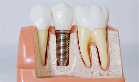 How Long Do Dental Implants Last Exploring Durability And Lifespan