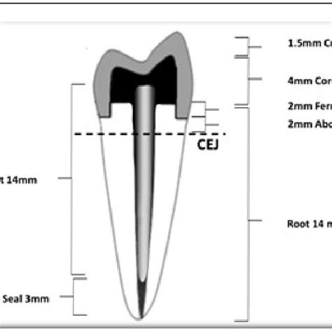 Endocrown preparation. | Download Scientific Diagram