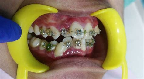 Fake Braces Can Cause Permanent Damage On Your Health Smileway Dental