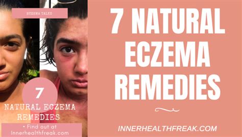 7 NATURAL ECZEMA REMEDIES – Inner Health Freak