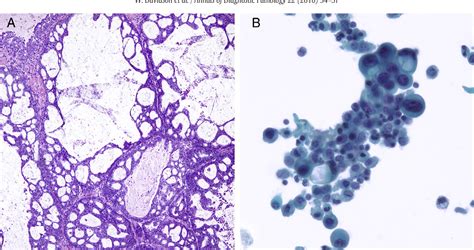 Figure 1 from Utility of peritoneal washing cytology in staging and ...