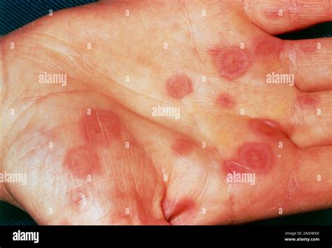 Erythema Multiforme Rash On A Patients Hand This Skin Disorder Starts With Itchy Spots Which