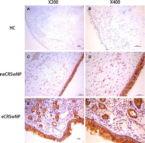 The Alcam Protein Expression In The Tissue Based On Ihc Representative