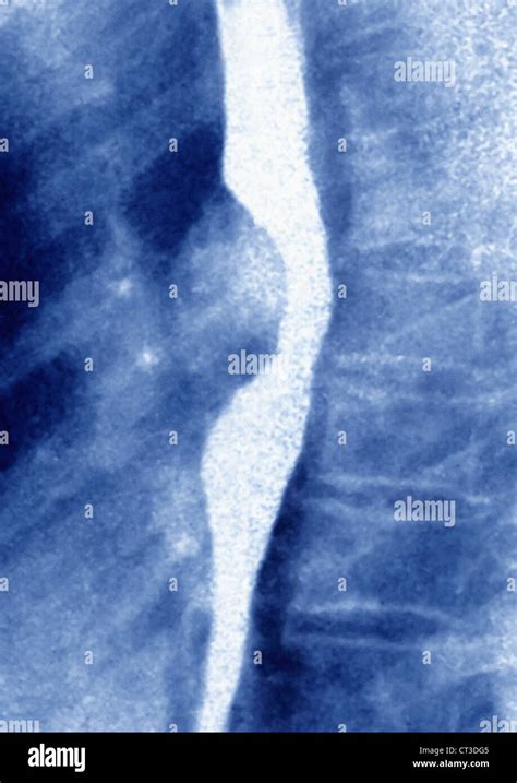 Leiomioma Esof Gico Rayos X Fotograf A De Stock Alamy