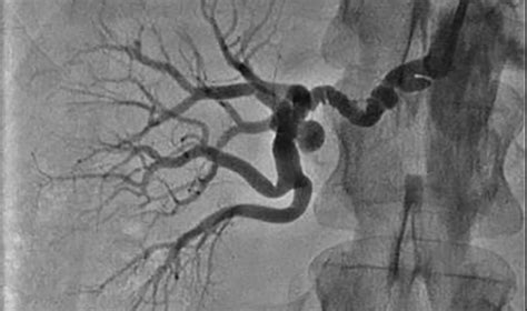 southeastern fmd  scad symposium emory daily pulse