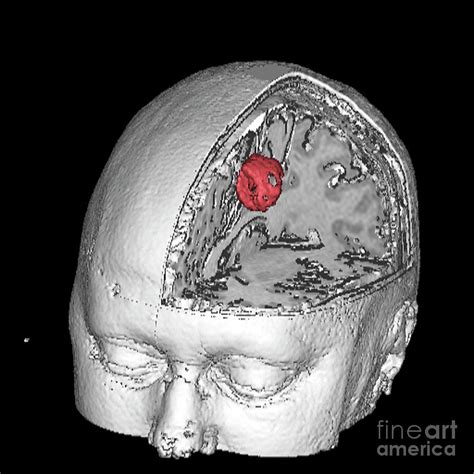 Brain Tumour Photograph By Simon Fraser Science Photo Library Fine