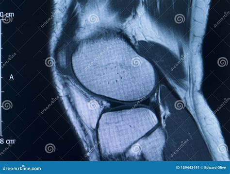 Knee Injury Mri Mcl Tear Stock Image Image Of Ligament 159443491