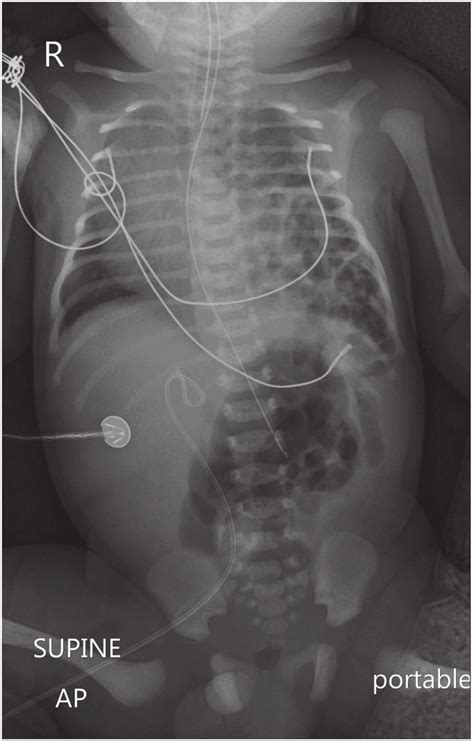 A Portable X Ray Photo Of The Chest Abdomen And Pelvis Shows The Right