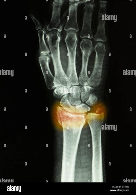 Ulnar Styloid Fracture Splint