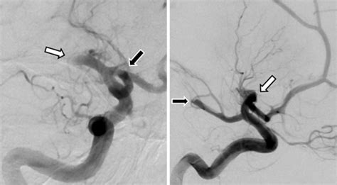 Pretreatment Cerebral Angiography With Anteroposterior Ap Left And