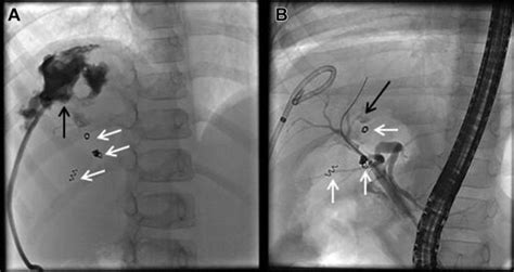 A Contrast Through Percutaneous Drain Demonstrating Communication Download Scientific Diagram