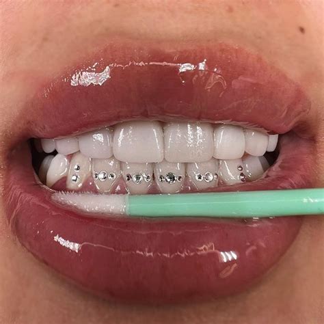 Tooth Gems Melbourne Teeth Whitening🧚‍♀️ • Catherine Hyland On