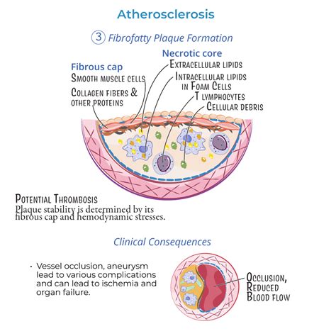 Clinical Pathology Glossary Atherosclerosis Fibrofatty Plaque