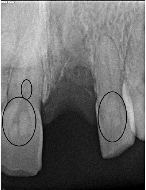 A Periapocal Radiograph Of Upper Central And Lateral Incisors Showing