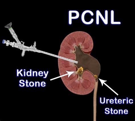 Kidney Stone Laser Surgery - Advanced Medical Surgery News | Modern Care Clinics | Blog