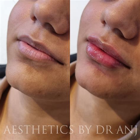 Dr Anjuli Patel Aesthetics By Dr Anj