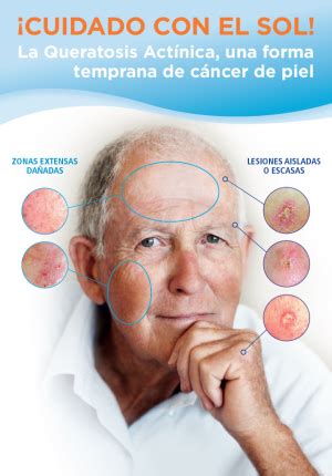 Queratosis actínica Centro Dermatológico Amparo Rodríguez