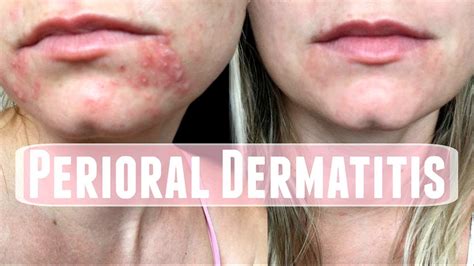 Perioral Dermatitis How I Treated It YouTube