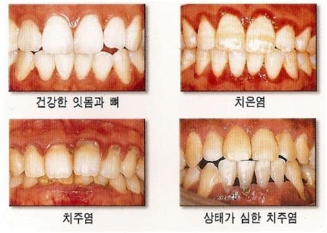 치주질환의 진행과정 네이버 블로그