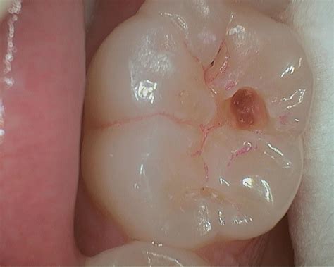 sweet tooth: occlusal caries