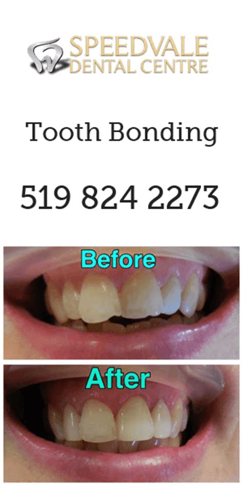 Tooth Bonding Treatments in Guelph | Speedvale Dental